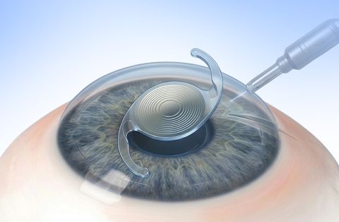 Refractive Cataract Surgery MICS